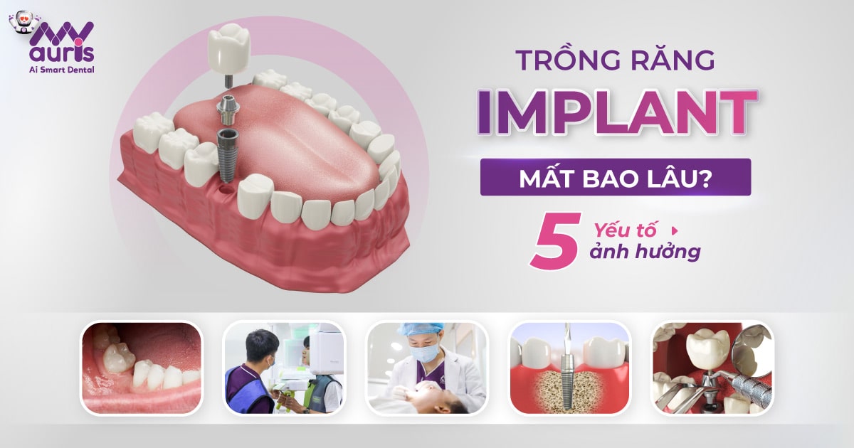 Trồng răng implant mất bao lâu