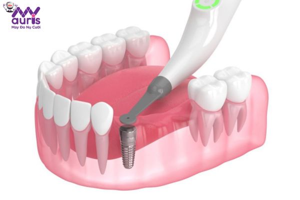 Những giai đoạn chính trong quá trình trồng răng Implant tương ứng thời gian cụ thể
