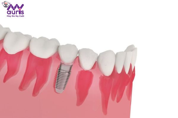 Giải đáp trồng răng Implant mất bao nhiêu thời gian?