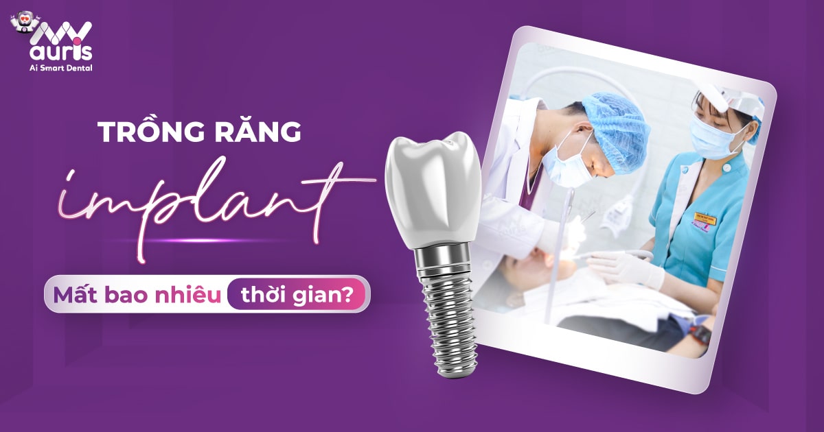 [Chia sẻ] Trồng răng Implant mất bao nhiêu thời gian?