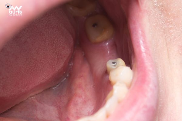Trồng răng là gì? Những trường hợp cần trồng răng giả? 