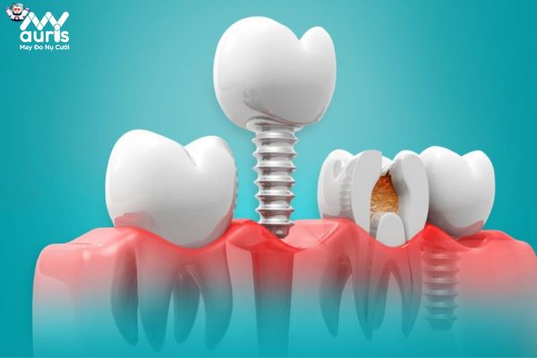 Giải đáp trồng răng số 6 có đau không với kỹ thuật cấy ghép Implant?