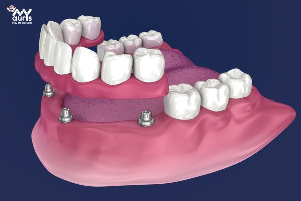 Trồng răng implant 2 hàm 