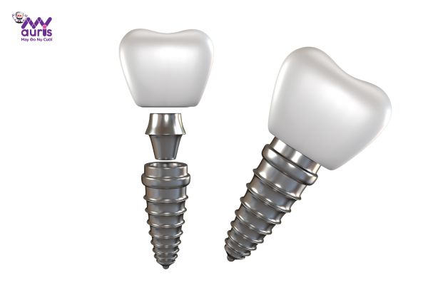 Vật liệu, chất lượng răng giả - Các tiêu chí ảnh hưởng đến trồng răng sứ implant giá bao nhiêu