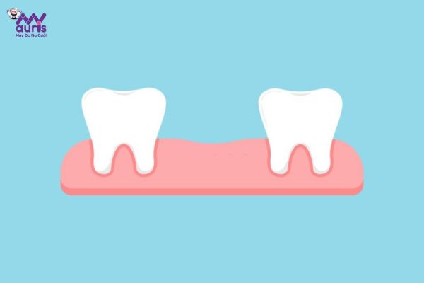 Số lượng răng mất - Các tiêu chí ảnh hưởng đến trồng răng sứ implant giá bao nhiêu