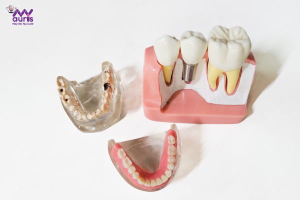 Trồng răng là gì?