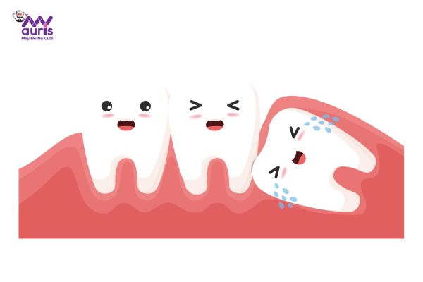 triệu chứng mọc răng khôn 