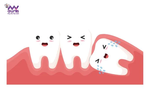 triệu chứng mọc răng khôn 