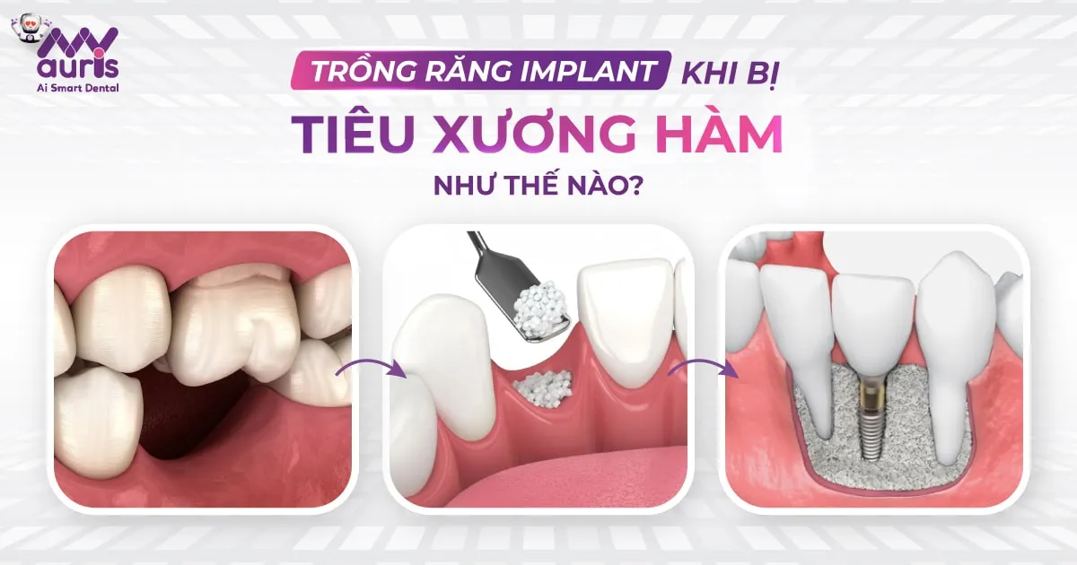 trồng răng implant khi bị tiêu xương hàm