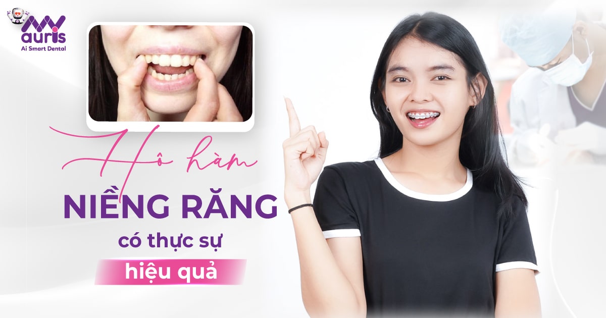 hô hàm niềng răng