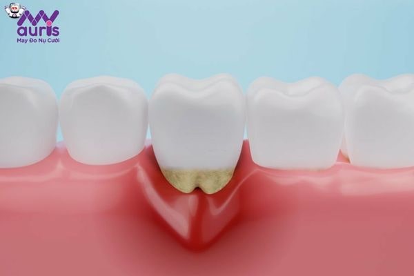 Hở cổ chân răng là trường hợp trong các hậu quả bọc răng sứ giá rẻ
