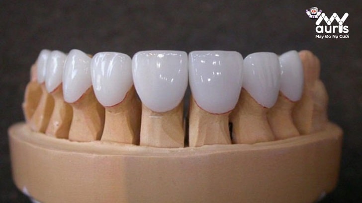 bọc răng sứ cho 4 răng cửa bị hô
