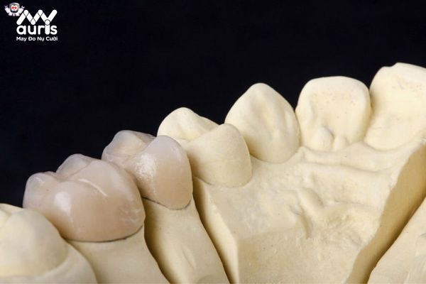 Giải đáp bọc răng sứ sau 10 năm có cần làm lại không?