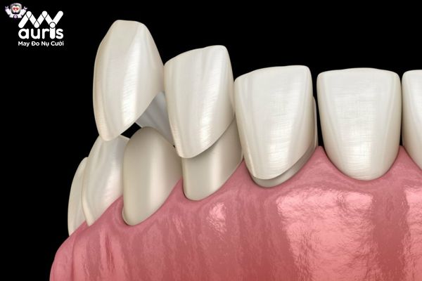 Yếu tố làm ảnh hưởng đến mức phí điều trị bọc sứ răng sâu