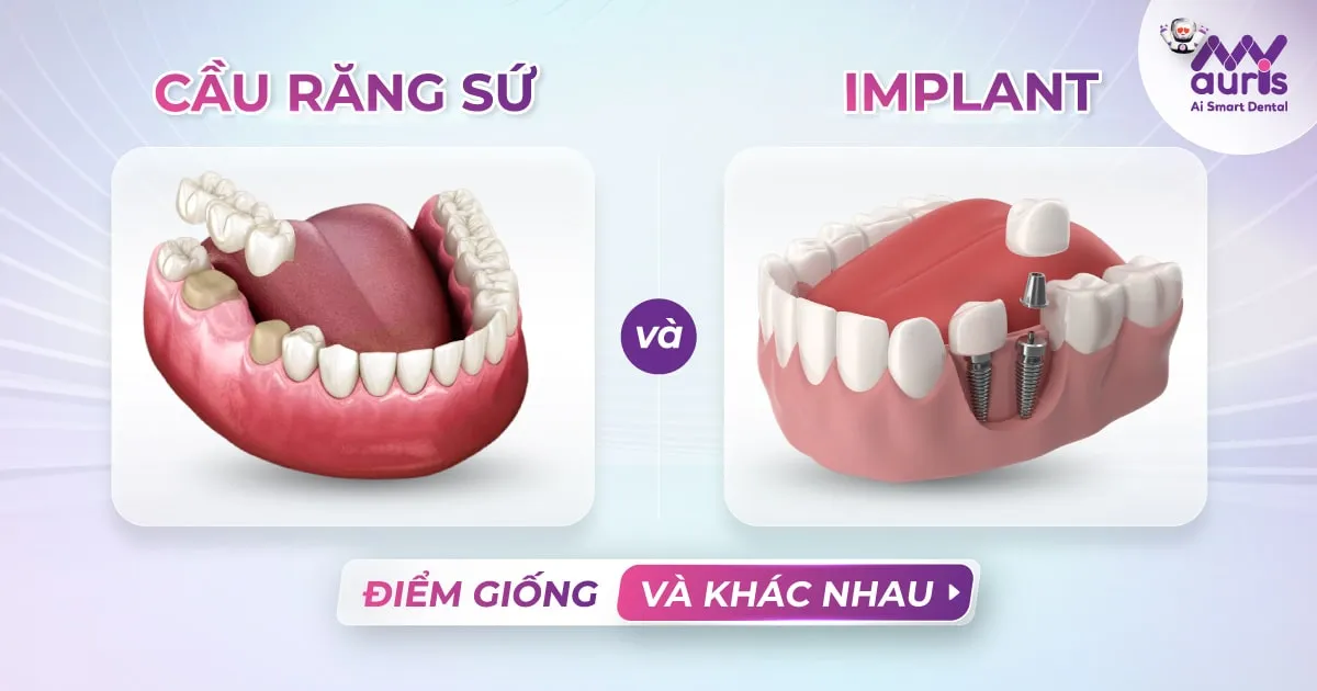 Cầu răng sứ và Implant: Giống và khác nhau như thế nào?