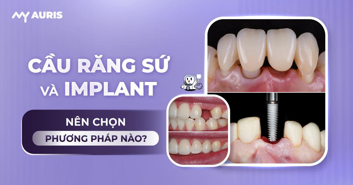 cầu răng sứ và implant,cầu răng và implant,răng sứ implant