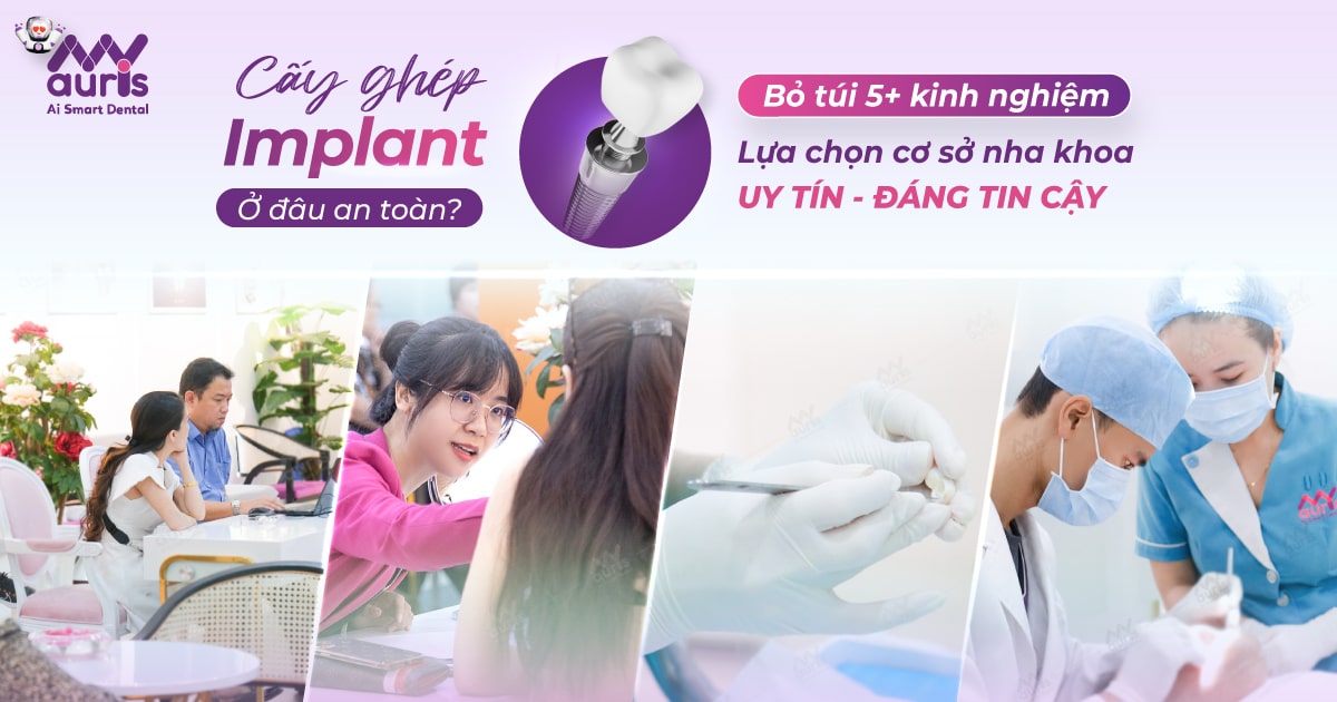 Cấy ghép implant ở đâu an toàn