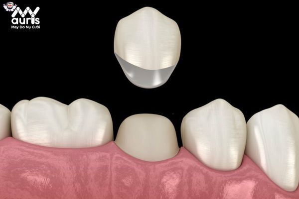 Gắn răng sứ tạm sau khi mài răng là gì?