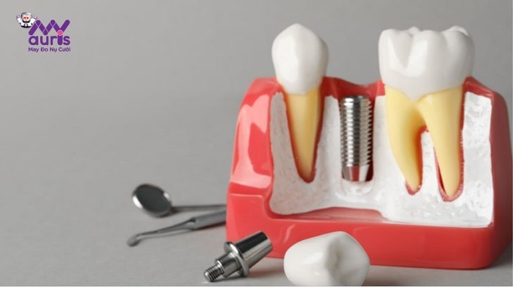 giá của trồng răng implant