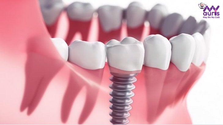 giá của trồng răng implant