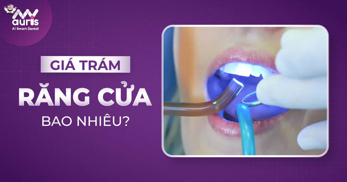 Giá trám răng cửa - 4 yếu tố ảnh hưởng chi phí điều trị