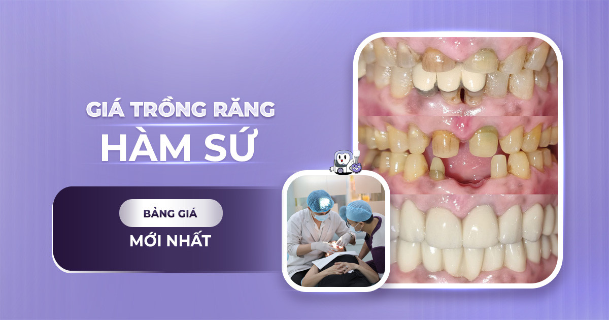 Giá Trồng Răng Hàm Sứ