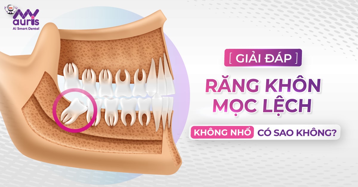 Răng khôn mọc lệch không nhổ có sao không?