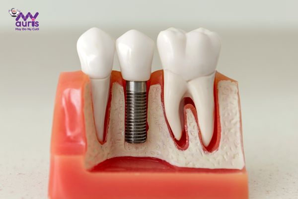 trồng răng implant bao lâu 