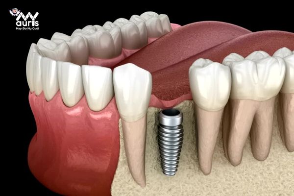  trồng răng implant bao lâu 
