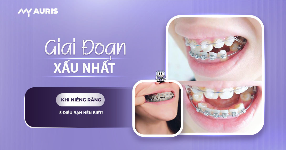 giai đoạn xấu nhất khi niềng răng