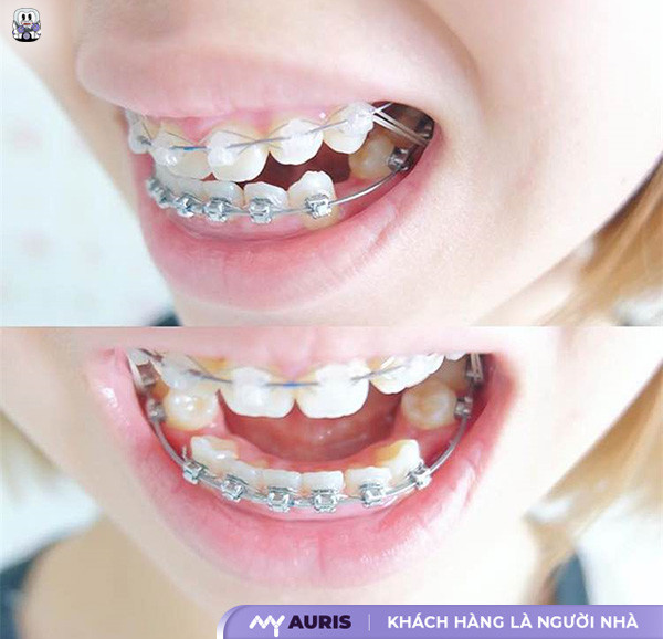 giai đoạn xấu nhất khi niềng răng