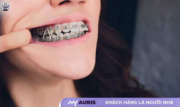 giai đoạn xấu nhất khi niềng răng