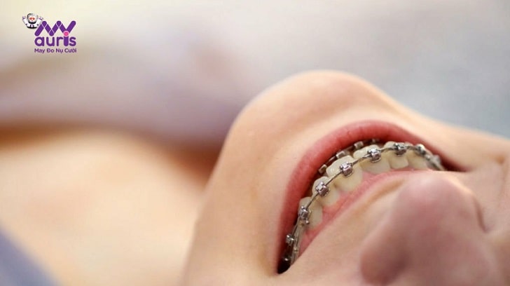 hàm lệch niềng răng