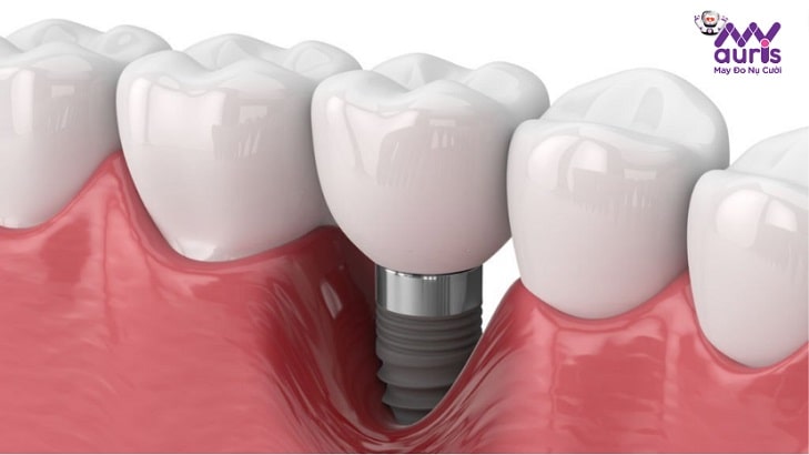 hiệu quả trồng răng implant