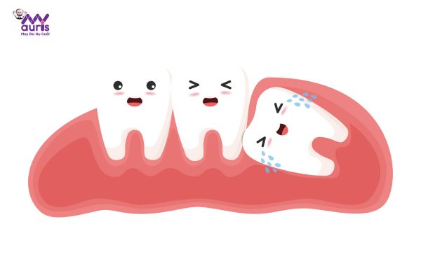 răng khôn mọc lệch nhưng không đau có nên nhổ 