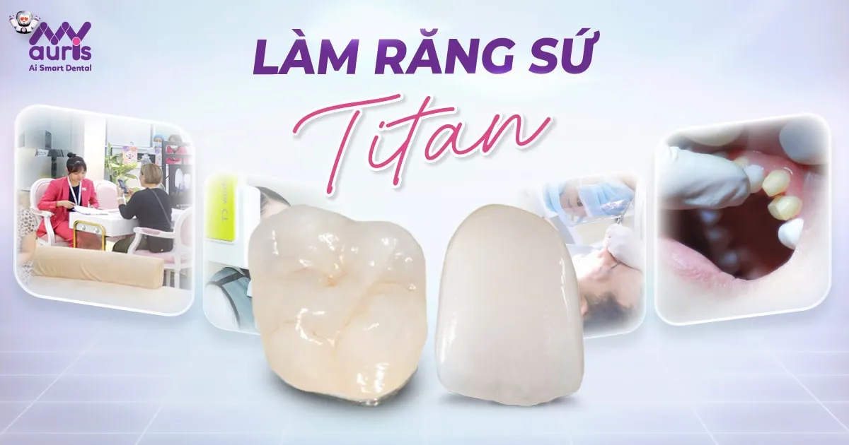Làm răng sứ titan có tốt không? Quy trình 5 bước