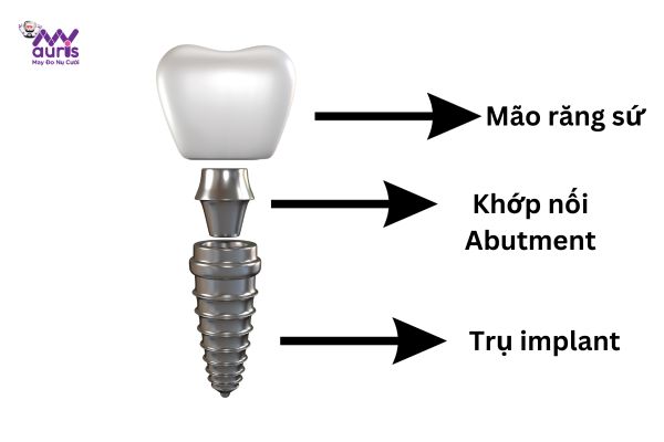  trồng răng công nghệ implant 