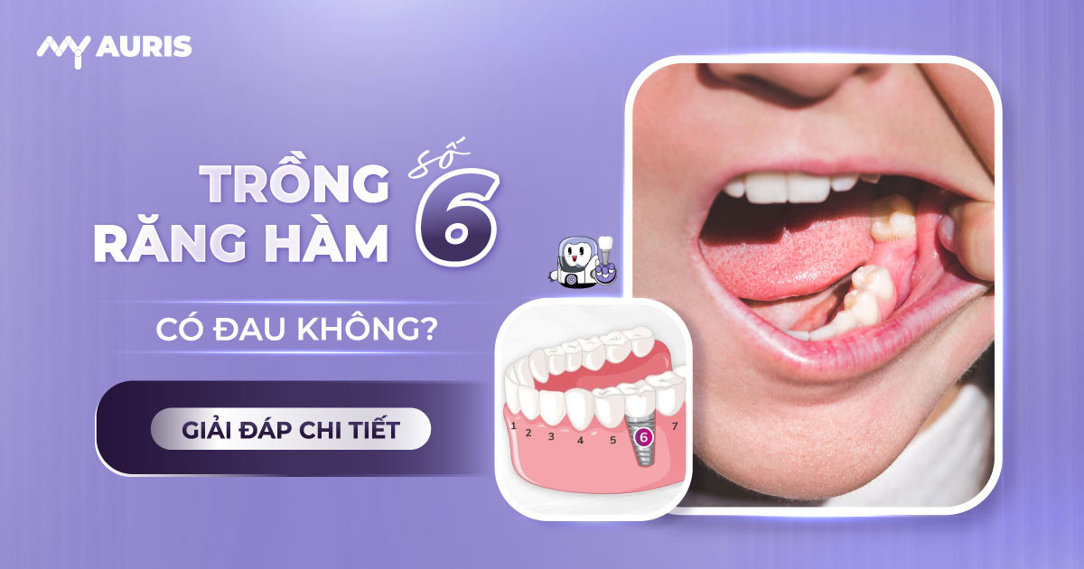 trồng răng hàm số 6 có đau không ,trồng răng số 6 có đau không,trồng răng hàm đau không