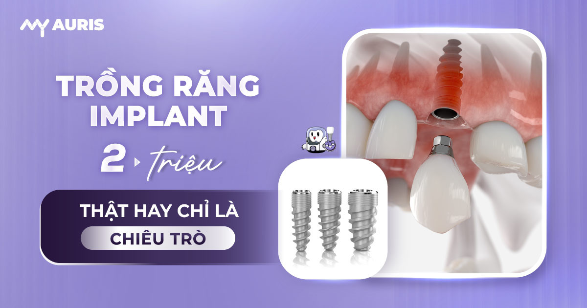trồng răng implant 2 triệu