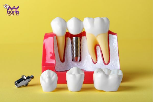  trồng răng implant mỹ 