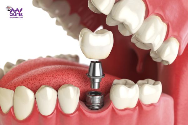 trồng răng implant nhanh nhất