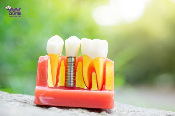 Trồng răng implant nhanh nhất có không?