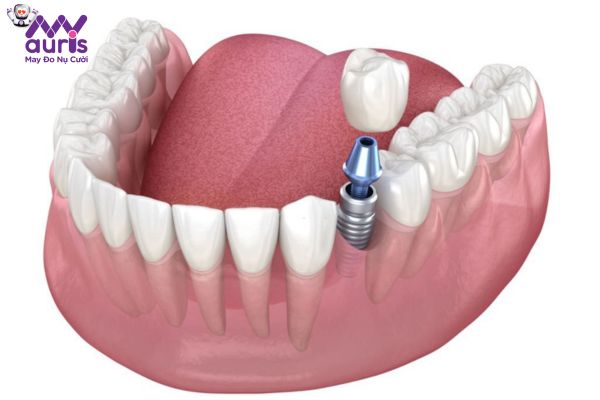 Trồng răng với phương pháp trồng răng Implant