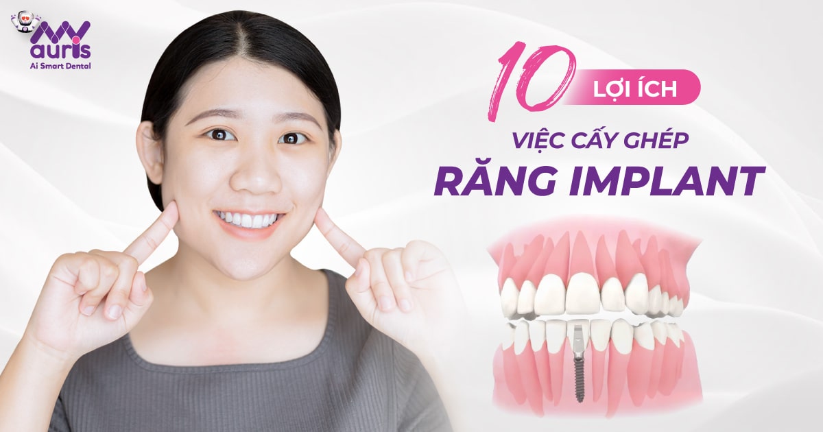 lợi ích của việc cấy ghép răng implant