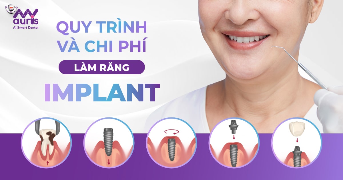 làm răng cắm implant