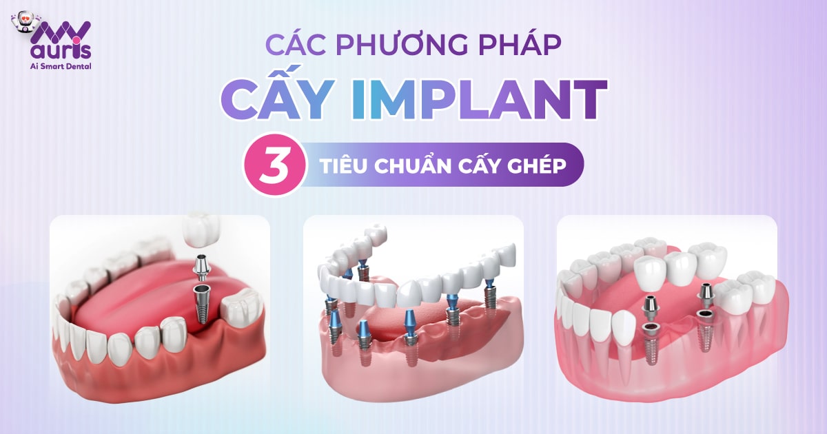 các phương pháp cấy implant