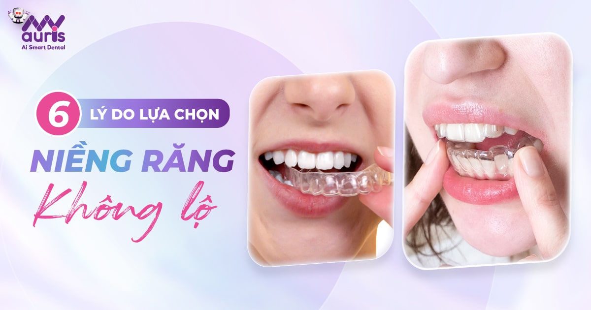 niềng răng không bị lộ