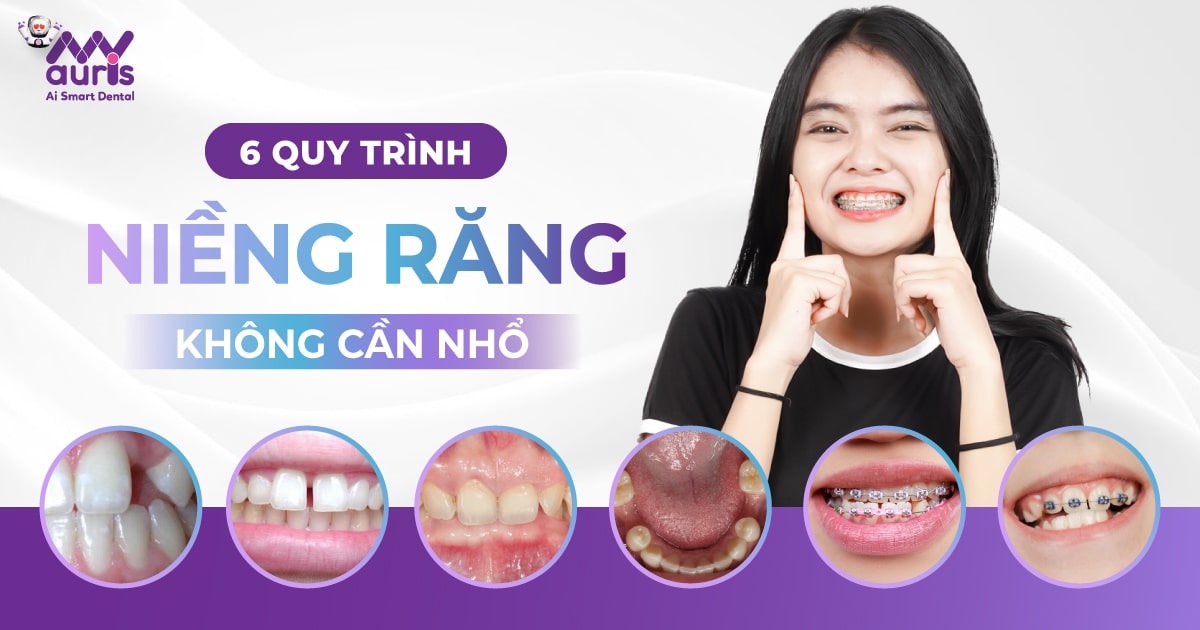 niềng răng ko cần nhổ