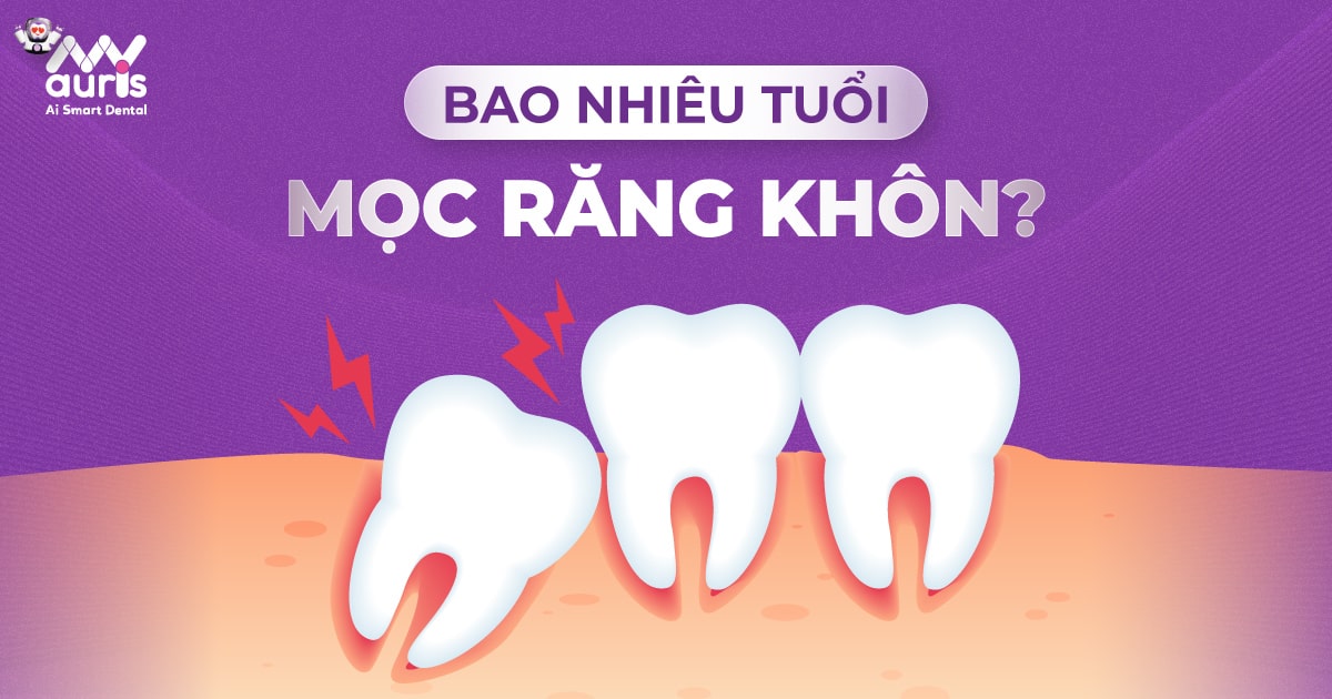 Bao nhiêu tuổi mọc răng khôn? - 5 trường hợp nên nhổ