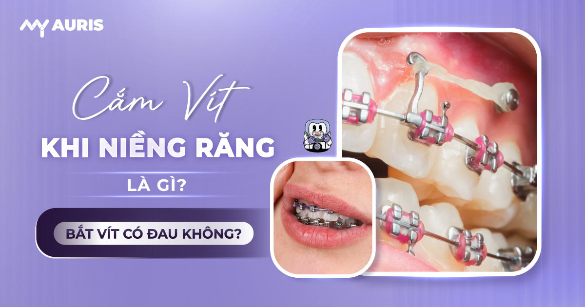 bắt vít niềng răng có đau không
